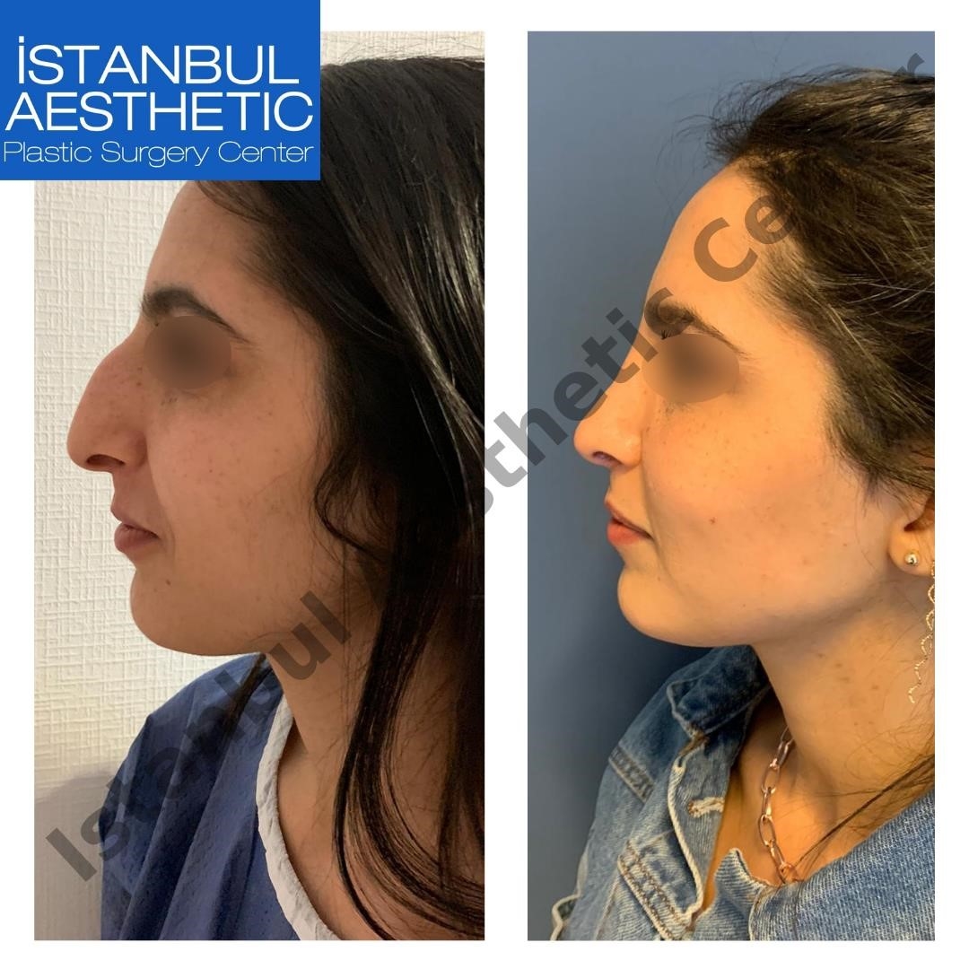 closed rhinoplasty near me