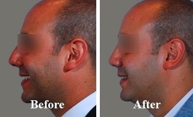 closed rhinoplasty