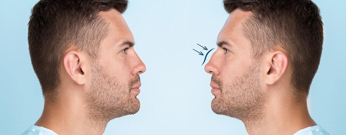 closed rhinoplasty near me