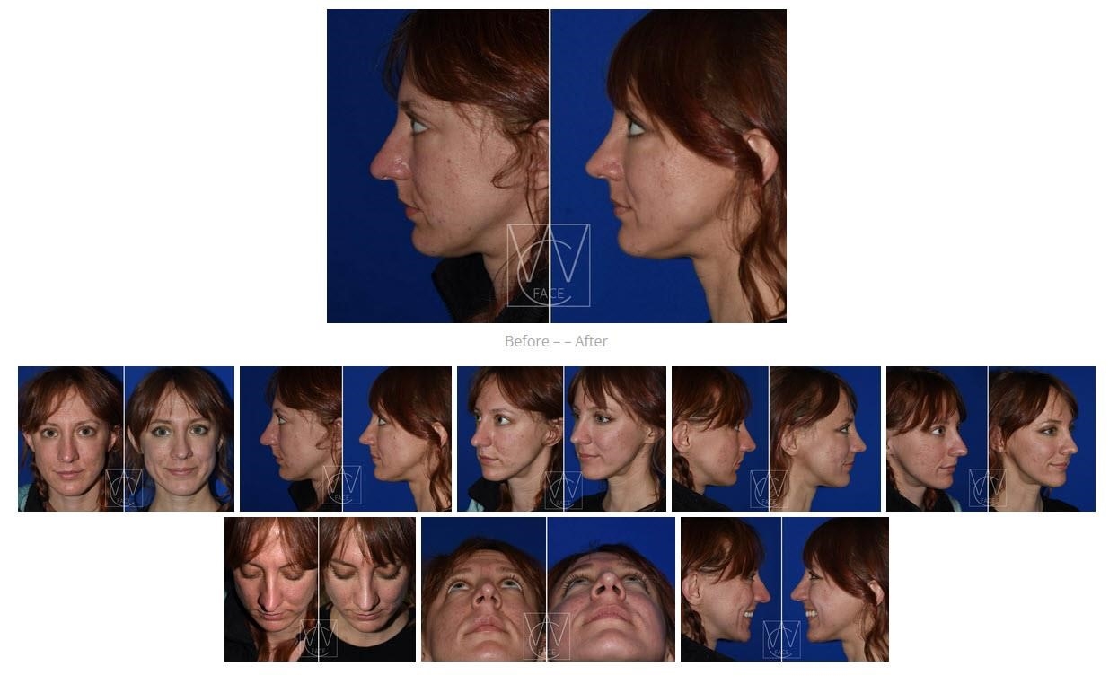 closed rhinoplasty near me