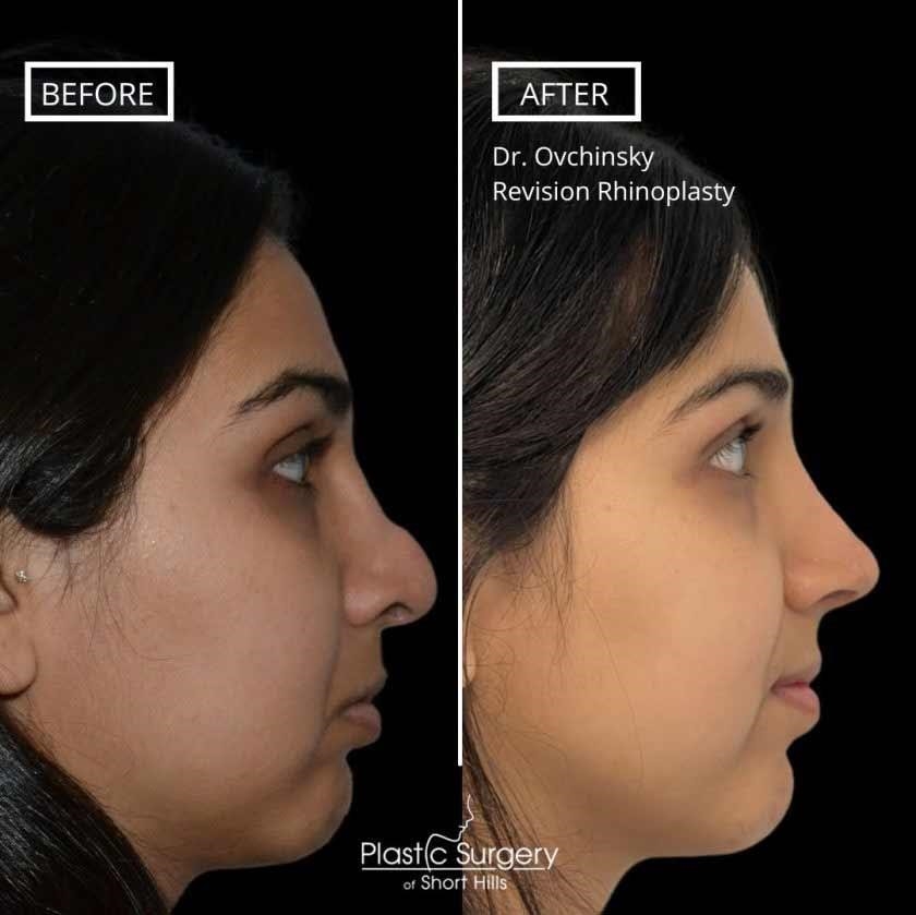 closed rhinoplasty