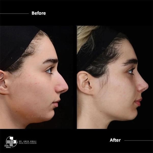 closed rhinoplasty